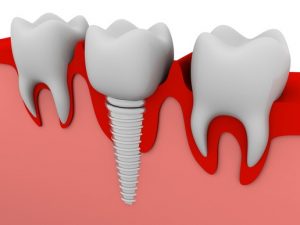 Dental Implant Illustration