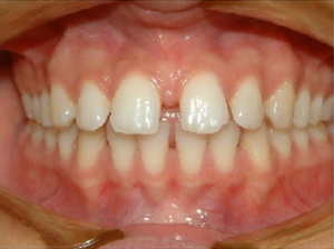 Invisalign Before