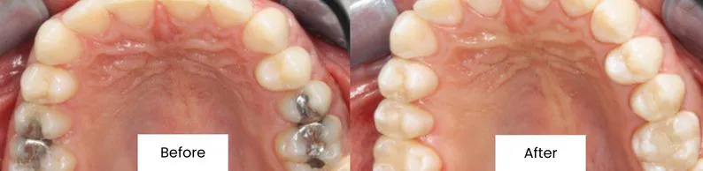 Before After Cosmetic Bonding At Creedmoor Road