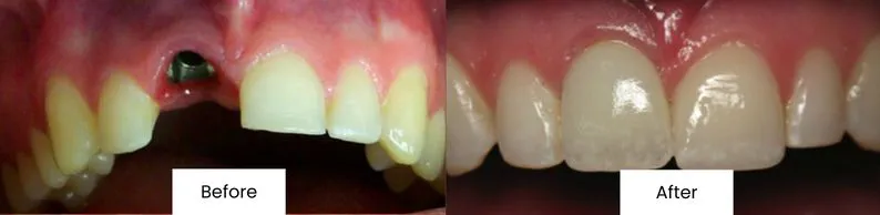 Before After Dental Implant Treatment