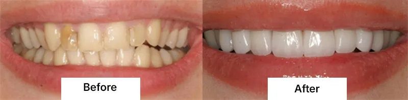 Before After Porcelain Veeners Treatment At Creedmoor Road