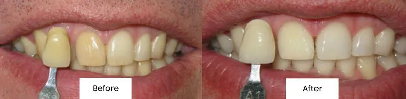 Before After Teeth Whitening At Creedmoor Road