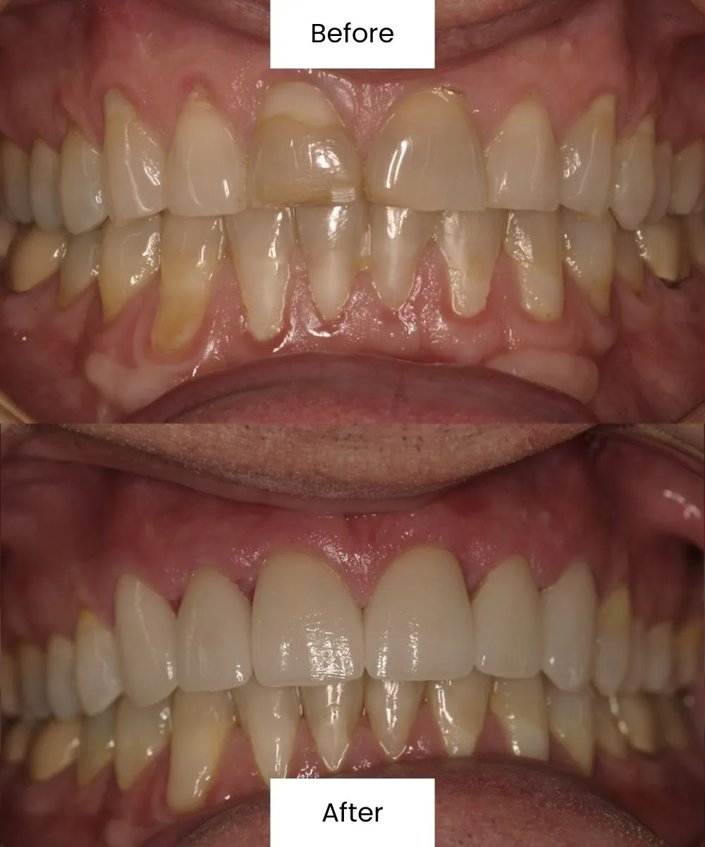 Before After Dental Treatment At Creedmoor Road