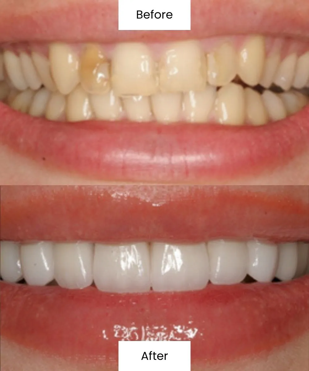 Before After Dental Treatment At Creedmoor Road