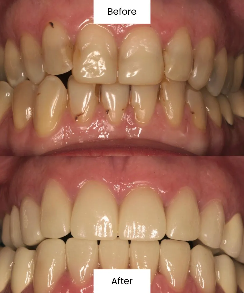 Before After Dental Treatment At Creedmoor Road