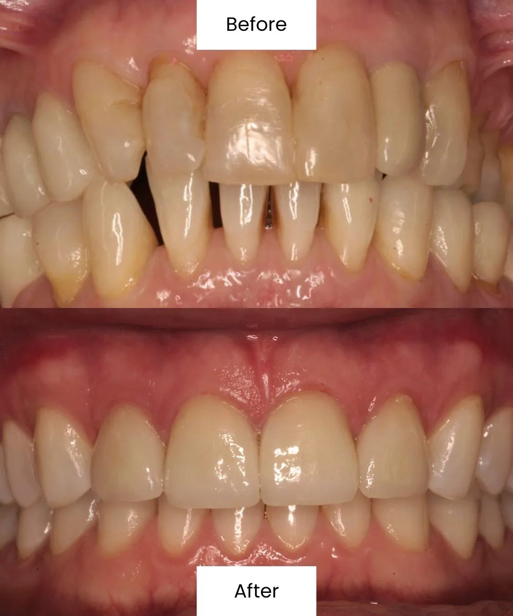 Before After Dental Treatment At Creedmoor Road