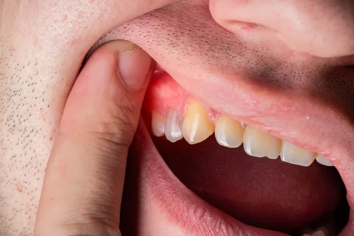 Gum Disease Treatment