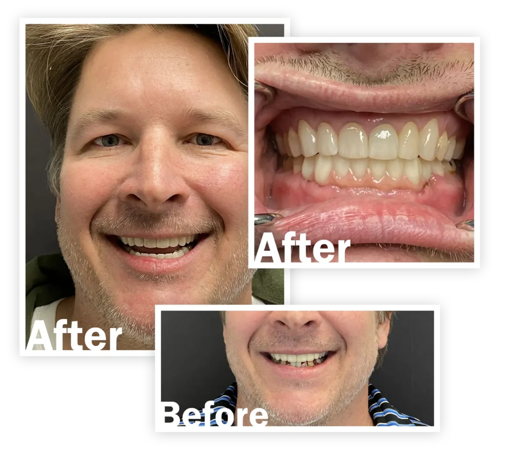 Before & After Raleigh Full Mouth Dental Implants Patient