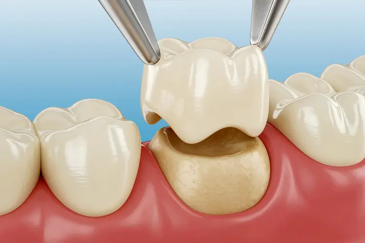 Dental Crown Illustration