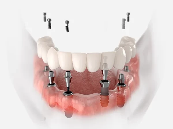 Full Arch Dental Implants Illustration