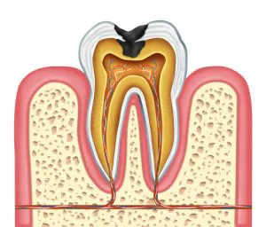 Tooth Inner Anatomy Of A Cavity