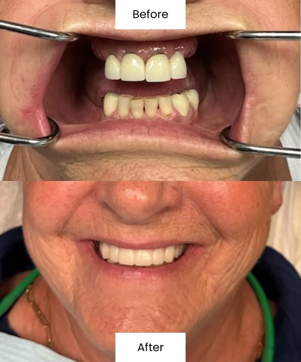 Before And After Photos Showing A Patient’s Restored Smile At Creedmoor Road General Dentistry