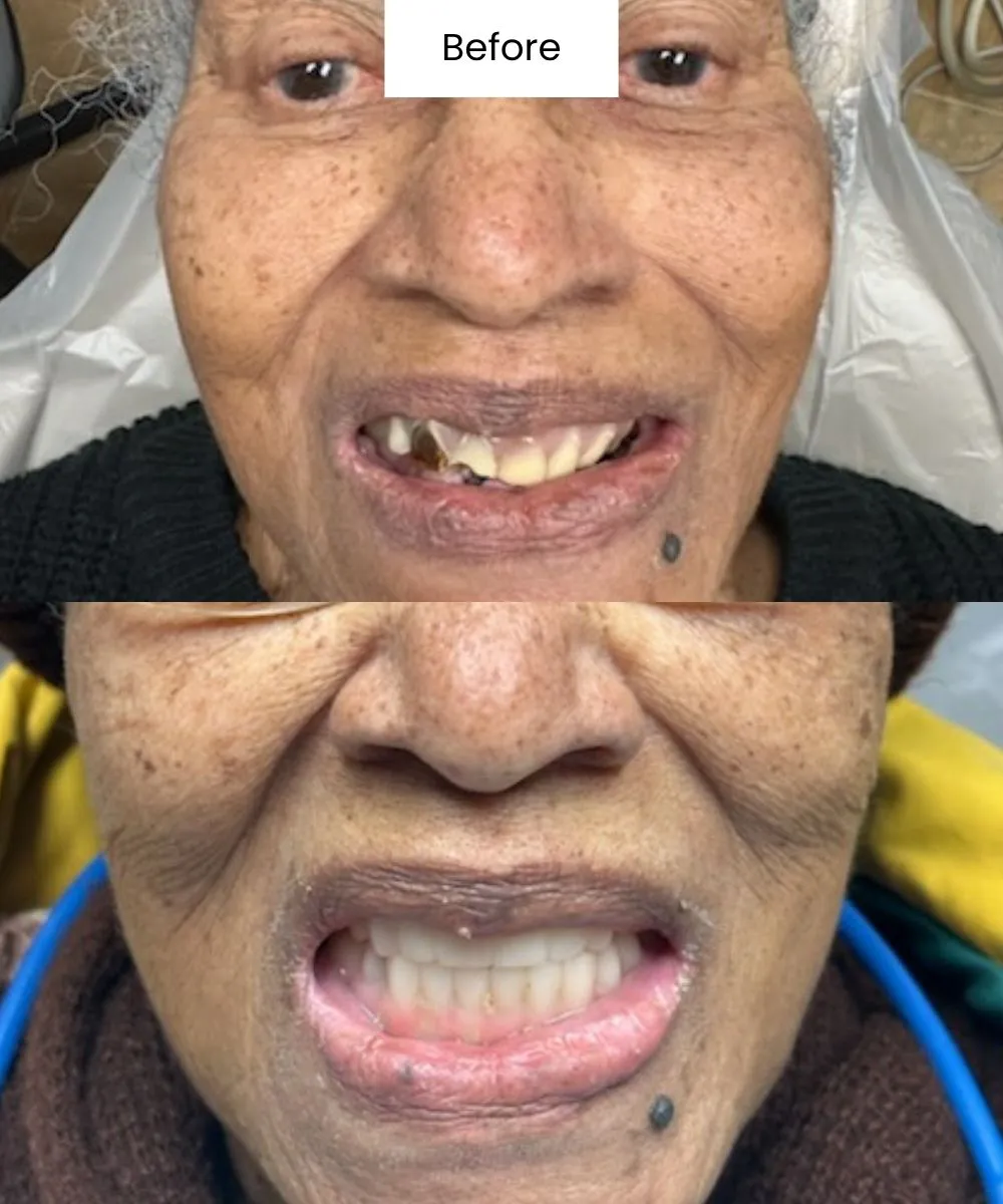 Before And After Photos Showing A Patient’s Full Smile Restoration At Creedmoor Road General Dentistry