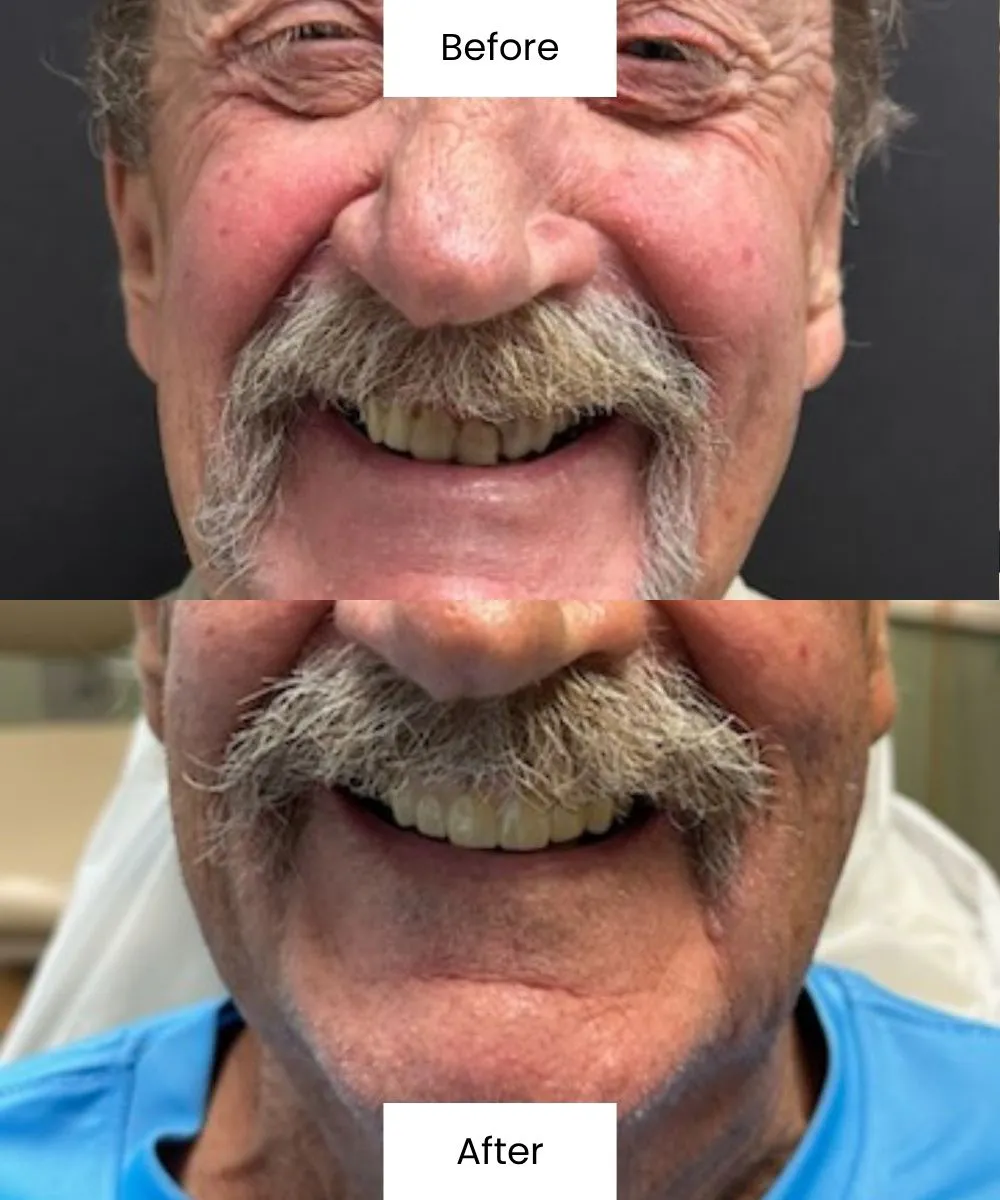 Before And After Photos Showing A Patient’s Improved Smile At Creedmoor Road General Dentistry