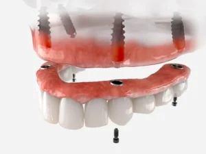 All on 4 Dental Implants Illustration